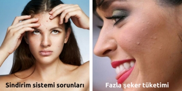 bedenin-farkli-bolgelerinde-cikan-sivilcelerin-sebeplerini-ve-onlarla-bas-etme-prosedurlerini-anlatiyoruz-sVSUCiOA.jpg